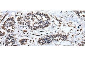 Immunohistochemistry of paraffin-embedded Human esophagus cancer tissue using HNRNPH2 Polyclonal Antibody at dilution of 1:40(x200) (HNRNPH2 antibody)