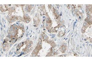 ABIN6278655 at 1/100 staining Human prostate tissue by IHC-P. (MAP3K1 antibody  (pThr1402))