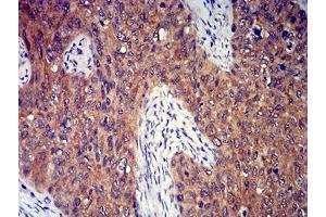 Immunohistochemical analysis of paraffin-embedded cervical cancer tissues using P2RY8 mouse mAb with DAB staining. (P2RY8 antibody)