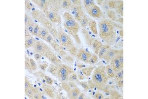 Immunohistochemistry of paraffin-embedded human liver cancer using BLVRB antibody at dilution of 1:100 (40x lens). (BLVRB antibody)