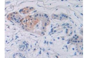 Detection of SUMF1 in Human Prostate cancer Tissue using Polyclonal Antibody to Sulfatase Modifying Factor 1 (SUMF1) (SUMF1 antibody  (AA 113-356))