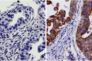 Paraffin embedded human gastric cancer tissue was stained with Mouse IgG2b-HRP isotype control followed by DAB and hematoxylin. (Cytokeratin 18 antibody  (HRP))