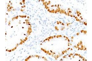 Formalin-fixed, paraffin-embedded human lung Adenocarcinoma stained with TTF1 antibody (NX2. (TTF1 antibody)