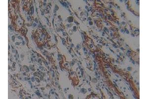 DAB staining on IHC-P; Samples: Human Lung cancer Tissue (Nischarin antibody  (AA 1246-1346))
