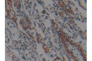 DAB staining on IHC-P; Samples: Human Lung cancer Tissue