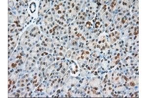 Immunohistochemical staining of paraffin-embedded Adenocarcinoma of Human colon tissue using anti-USP5 mouse monoclonal antibody. (USP5 antibody)