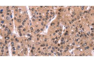 Immunohistochemistry of paraffin-embedded Human liver cancer using ARC Polyclonal Antibody at dilution of 1:50 (ARC antibody)