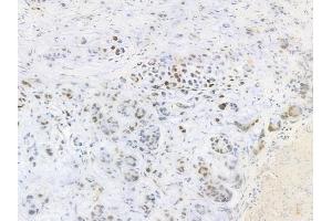 ABIN6256428 and ABIN6267317 at 1/100 staining human gastric carcinoma by IHC-P. (Retinoblastoma Protein (Rb) antibody  (pSer807))