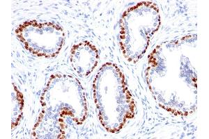 Formalin-fixed, paraffin-embedded human Prostate Cancer stained with p63 Rabbit Monoclonal Antibody (TP63/1423R). (p63 antibody)