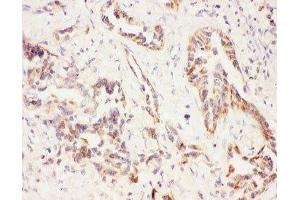 IHC-P: Eotaxin 3 antibody testing of human lung cancer tissue (CCL26 antibody  (AA 24-94))