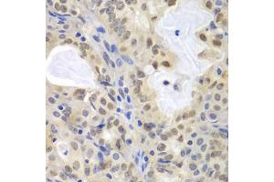 Immunohistochemistry of paraffin-embedded human oophoroma using MCM3 antibody (ABIN5970419) at dilution of 1/100 (40x lens). (MCM3 antibody)