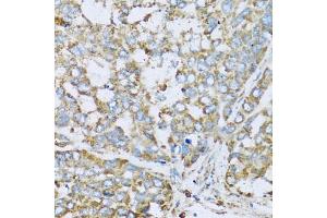 Immunohistochemistry of paraffin-embedded human liver cancer using COX6A1 antibody.