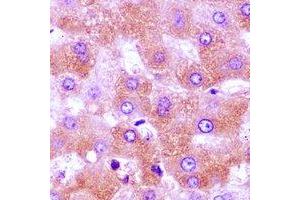 Immunohistochemical analysis of CBLB staining in human liver cancer formalin fixed paraffin embedded tissue section. (Cbl Proto-Oncogene B, E3 Ubiquitin Protein Ligase (CBLB) antibody)