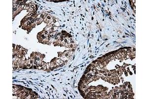 Immunohistochemical staining of paraffin-embedded Carcinoma of liver tissue using anti-PSMC3 mouse monoclonal antibody. (PSMC3 antibody)