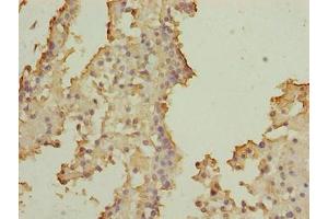 Immunohistochemistry of paraffin-embedded human breast cancer using ABIN7170508 at dilution of 1:100 (SOHLH2 antibody  (AA 1-225))