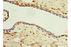 Immunohistochemistry of paraffin-embedded human breast cancer using ABIN7156854 at dilution of 1:100 (IL22 Receptor alpha 1 antibody  (AA 16-230))