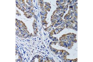 Immunohistochemistry of paraffin-embedded human gastric cancer using ATP5B antibody (ABIN5973391) at dilution of 1/100 (40x lens). (ATP5B antibody)
