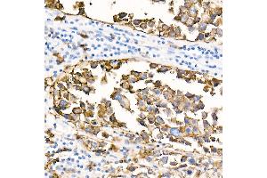 Immunohistochemistry of paraffin-embedded Human anaplastic large cell lymphoma using CD20 antibody (ABIN7268472) at dilution of 1:100 (40x lens).