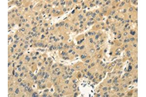 The image on the left is immunohistochemistry of paraffin-embedded Human liver cancer tissue using ABIN7130214(MED16 Antibody) at dilution 1/30, on the right is treated with fusion protein.