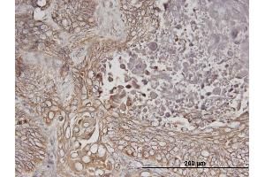 Immunoperoxidase of monoclonal antibody to ERBB3 on formalin-fixed paraffin-embedded human lung cancer. (ERBB3 antibody  (AA 1-130))