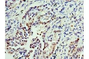 Immunohistochemistry of paraffin-embedded human lung cancer using ABIN7156290 at dilution of 1:100 (IMPDH2 antibody  (AA 215-514))