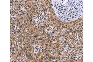 Immunohistochemistry of Human liver cancer using GLYR1 Polyclonal Antibody at dilution of 1:30 (GLYR1 antibody)