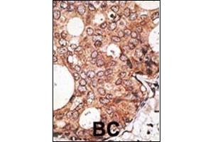 Formalin-fixed and paraffin-embedded human cancer tissue reacted with the primary antibody, which was peroxidase-conjugated to the secondary antibody, followed by AEC staining. (MAGEA10 antibody  (C-Term))