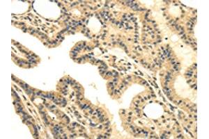 The image on the left is immunohistochemistry of paraffin-embedded Human thyroid cancer tissue using ABIN7130214(MED16 Antibody) at dilution 1/30, on the right is treated with fusion protein.