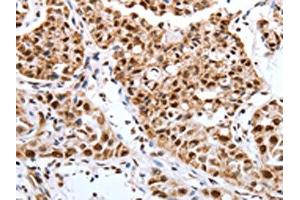 The image on the left is immunohistochemistry of paraffin-embedded Human lung cancer tissue using ABIN7193127(Map2 Antibody) at dilution 1/40, on the right is treated with synthetic peptide. (MAP2 antibody)