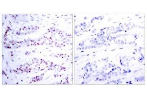 Immunohistochemical analysis of paraffin-embedded human breast carcinoma tissue using STAT6 (Ab-641) antibody (E021050). (STAT6 antibody)