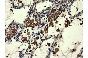 Immunohistochemical staining of paraffin-embedded Carcinoma of Human lung tissue using anti-MICAL1 mouse monoclonal antibody. (MICAL1 antibody)