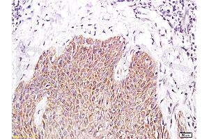Formalin-fixed and paraffin-embedded human skin psoriasis labeled with Rabbit Anti- PPARr Polyclonal Antibody, Unconjugated (ABIN669711) at 1:200 followed by conjugation to the secondary antibody and DAB staining (PPARG antibody  (AA 101-200))