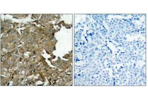 Immunohistochemical analysis of paraffin-embedded human breast carcinoma tissue using cofilin(Ab-3) Antibody(left) or the same antibody preincubated with blocking peptide(right). (Cofilin antibody  (AA 1-5))