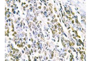 Immunohistochemistry analyzes of MRE11 antibody in paraffin-embedded human lung carcinoma tissue. (Mre11 antibody)