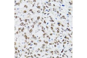 Immunohistochemistry of paraffin-embedded human liver cancer using MT antibody (ABIN6128251, ABIN6144117, ABIN6144118 and ABIN6222360) at dilution of 1:100 (40x lens). (MTA3 antibody  (AA 40-330))