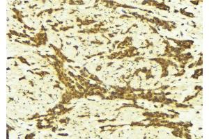 ABIN6269248 at 1/100 staining Human breast cancer tissue by IHC-P. (STAT5A antibody  (C-Term))