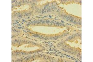 Immunohistochemistry of paraffin-embedded human endometrial cancer using ABIN7142784 at dilution of 1:100 (RPL26L1 antibody  (AA 1-145))