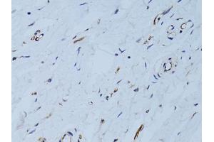 Immunohistochemistry of paraffin-embedded human breast using SELE Antibody (ABIN5971217) at dilution of 1/100 (40x lens). (Selectin E/CD62e antibody)