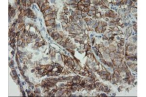 Immunohistochemical staining of paraffin-embedded Adenocarcinoma of Human ovary tissue using anti-CDH2 mouse monoclonal antibody.