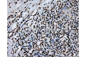 Immunohistochemical staining of paraffin-embedded Adenocarcinoma of ovary tissue using anti-DAPK2 mouse monoclonal antibody.