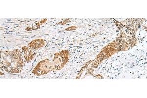 Immunohistochemistry of paraffin-embedded Human esophagus cancer tissue using HIST1H2BK Polyclonal Antibody at dilution of 1:40(x200) (HIST1H2BK antibody)