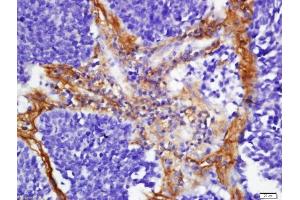 Formalin-fixed and paraffin embedded human lung carcinoma labeled with Anti-FHOD1 Polyclonal Antibody, Unconjugated  at 1:200 followed by conjugation to the secondary antibody and DAB staining (FHOD1 antibody  (AA 601-700))