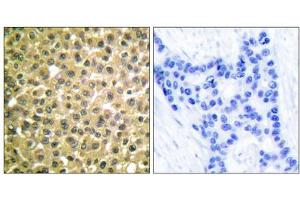 Immunohistochemical analysis of paraffin-embedded human breast carcinoma tissue using Retinoic Acid Receptor beta antibody (ABIN5976499). (Retinoic Acid Receptor beta antibody  (C-Term))