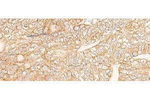 Immunohistochemistry of paraffin-embedded Human gastric cancer tissue using KRT9 Polyclonal Antibody at dilution of 1:30(x200) (KRT9 antibody)