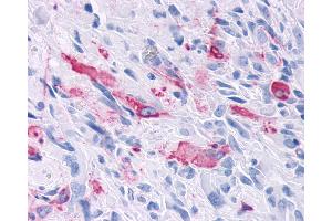 Anti-MRGD / MRGPRD antibody IHC of human Brain, Glioblastoma. (MRGPRD antibody  (Cytoplasmic Domain))