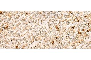 Immunohistochemistry of paraffin-embedded Human gastric cancer tissue using TBCK Polyclonal Antibody at dilution of 1:25(x200) (TBCK antibody)