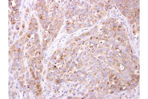 IHC-P Image ETNK1 antibody [N2C3] detects ETNK1 protein at cytosol on H358 xenograft by immunohistochemical analysis. (Ethanolamine Kinase 1 antibody)