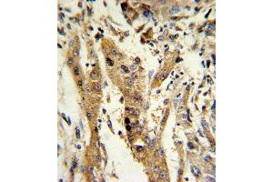 Formalin-fixed and paraffin-embedded human hepatocarcinoma reacted with GSTM1 Antibody (C-term), which was peroxidase-conjugated to the secondary antibody, followed by DAB staining. (GSTM1 antibody  (C-Term))