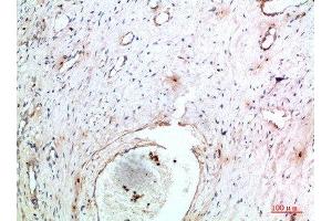 Immunohistochemical analysis of paraffin-embedded human-cervical-cancer, antibody was diluted at 1:200 (TNIP2 antibody  (AA 61-110))