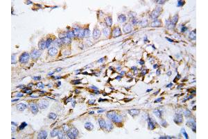 Anti-MIG antibody, IHC(P) IHC(P): Human Lung Cancer Tissue (CXCL9 antibody  (N-Term))